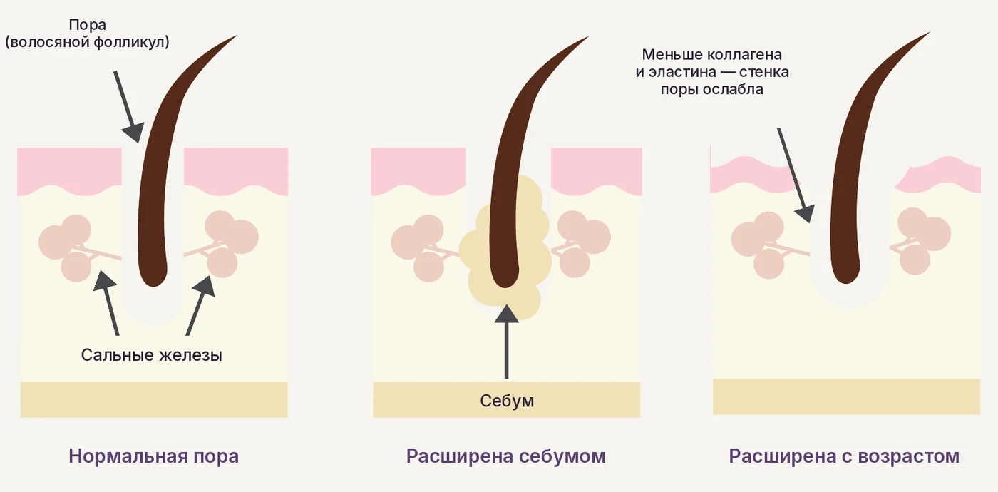 Нормальная и расширенная поры