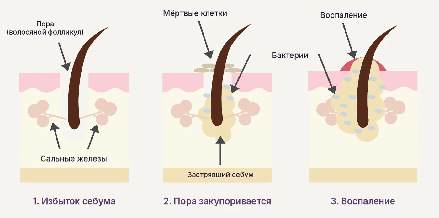 Три стадии формирования высыпания
